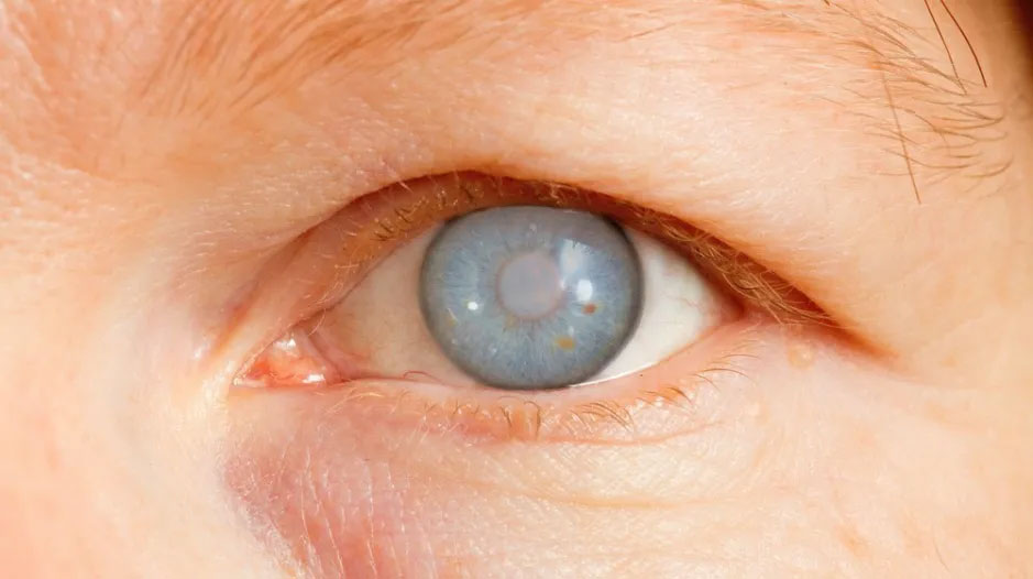Glaucoma Symptoms